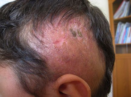 Alopecia la bărbați semnează cum să se oprească și să se scape