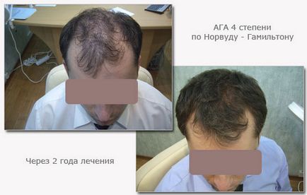 Alopecia la bărbați semnează cum să se oprească și să scape