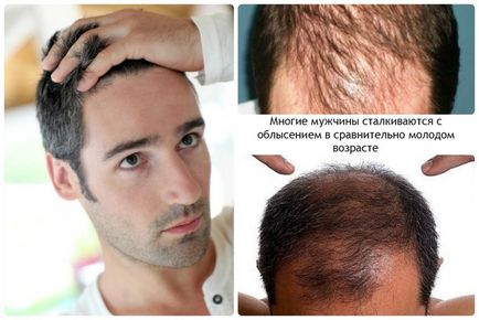 Alopecia la bărbați semnează cum să se oprească și să scape