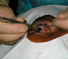 Chirurgie pentru a elimina pterigiul de ochi indicatii, recenzii, clinici, preturi
