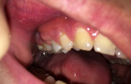 Umflarea gingiei in apropierea dintelui si doare - ce sa fac si cum sa tratezi, ghid pentru stomatologie
