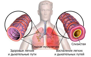 Szövődmények a tüdőben után influenza - Okok és kezelés