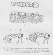 Caracteristicile proteticelor cu proteze de pod cu înclinarea (convergența) dinților protic,