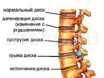 Osteocondroza 1, 2, 3, 4 grade de simptome și tratament