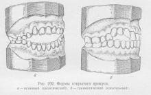 Відкритий прикус, ортопедична стоматологія