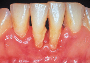 A periodontitis tünetei és kezelése, fotó súlyossága, a betegségek okait