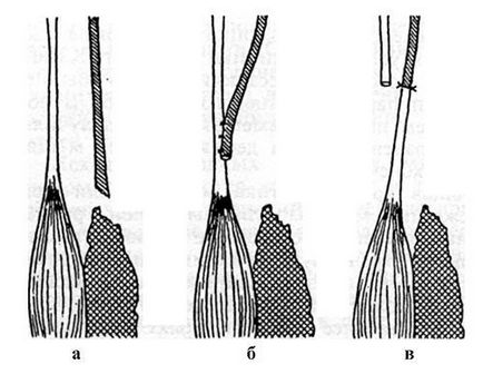 Plasticitatea defectelor musculare