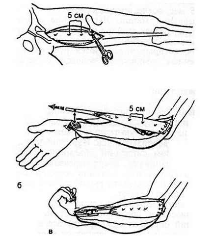 Plasticitatea defectelor musculare