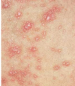 Simptome lichenice roșii și lipsite de tratament