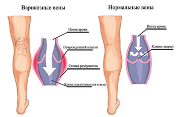 De ce umflarea picioarelor la bărbați și femei cum să vindece umflarea piciorului