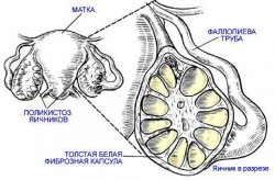 Ovarianul polichistic (spca)