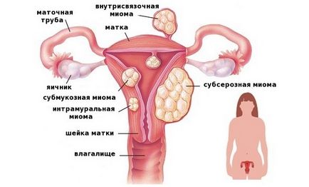 Наслідки після видалення матки з міомою