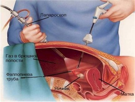 Consecințele după îndepărtarea uterului cu miomul