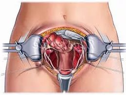 Consecințele după îndepărtarea uterului cu miomul