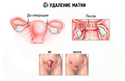 Consecințele după îndepărtarea uterului cu miomul