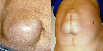 Hernia postoperatorie