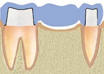 Disecția dinților pentru cermet