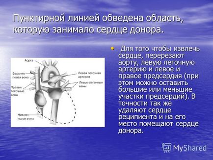 Презентація на тему пересадка серця в європі