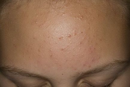 Cauza bolilor de piele poate fi o bifilară subcutanată