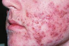 Cauze și tratament pentru acnee