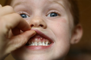 Pimple pe gumă de deasupra dinte într-o fotografie pentru adulți de soții albe, cauze și tratament