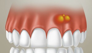 Pimple pe gumă de deasupra dinte într-o fotografie pentru adulți de soții albe, cauze și tratament