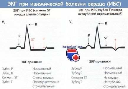 Ознаки атипової стенокардії на ЕКГ стенокардії Принцметала, німий ішемії міокарда