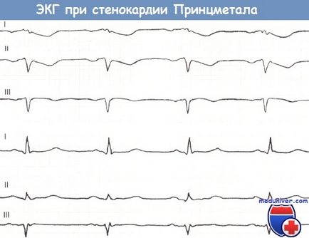 Ознаки атипової стенокардії на ЕКГ стенокардії Принцметала, німий ішемії міокарда