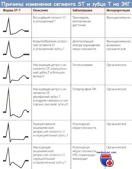 Ознаки атипової стенокардії на ЕКГ стенокардії Принцметала, німий ішемії міокарда