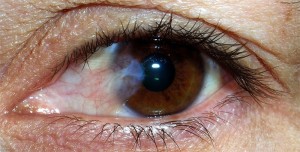 Pterygium ochii după precauții de intervenție chirurgicală