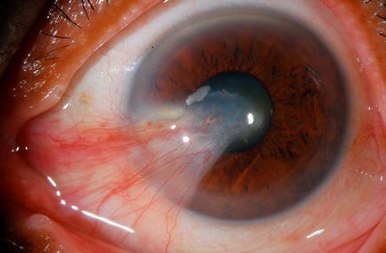 Pterygium cauzele ochilor, simptome, chirurgie cu laser, fotografie, video