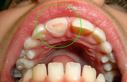 Celuloza dintelui ce este si cum se trateaza inflamatia