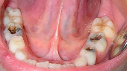 Пульпа зуба що це таке і як лікувати запалення