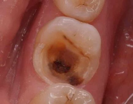 Пульпа зуба що це таке і як лікувати запалення