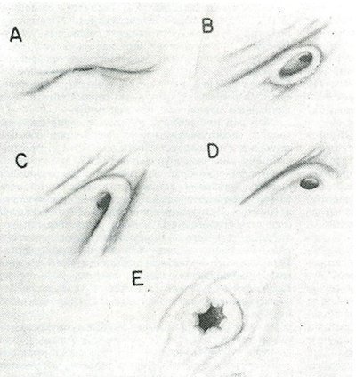 Chlamidia reflux