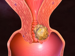 Cancer de col uterin fotografii vii ale stadiului de dezvoltare a cancerului