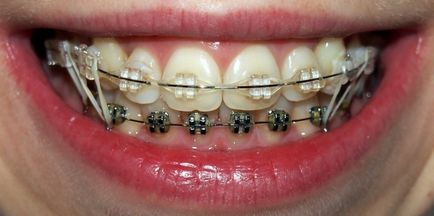 Sapphire braces - fotografie și descrierea opțiunilor