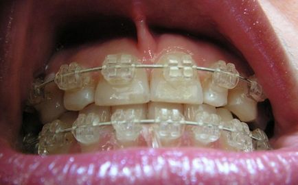 Sapphire braces - fotografie și descrierea opțiunilor