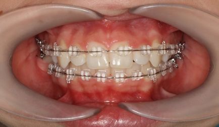 Sapphire braces - fotografie și descrierea opțiunilor