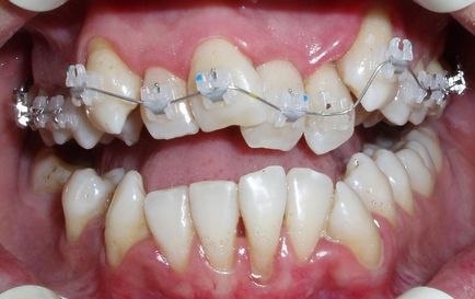 Sapphire braces - fotografie și descrierea opțiunilor