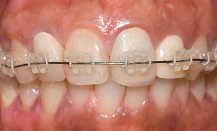 Sapphire braces - fotografie și descrierea opțiunilor