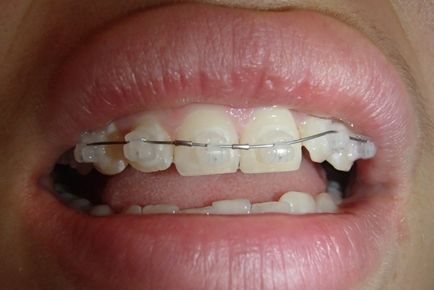 Sapphire braces - fotografie și descrierea opțiunilor