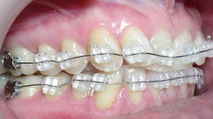 Sapphire braces - fotografie și descrierea opțiunilor