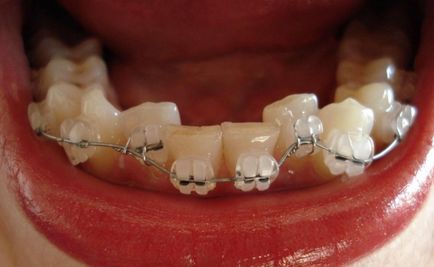 Sapphire braces - fotografie și descrierea opțiunilor