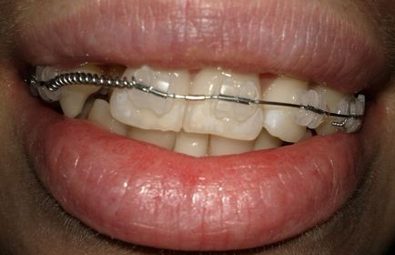 Sapphire braces - fotografie și descrierea opțiunilor