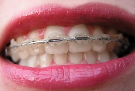 Sapphire braces - fotografie și descrierea opțiunilor