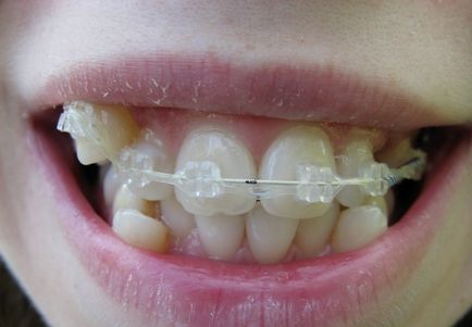 Sapphire braces - fotografie și descrierea opțiunilor