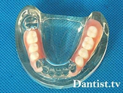 Знімні зубні м'які протези ціна, види і фото
