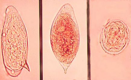 Schistosomiasis simptome, semne, tratament și prevenire