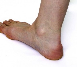 Шпора на нозі причини появи, діагностика, лікування